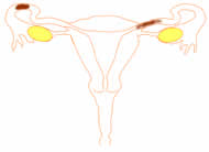 distal and proximal blocked fallopian tubes