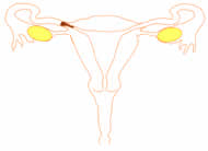 proximal blocked fallopian tube